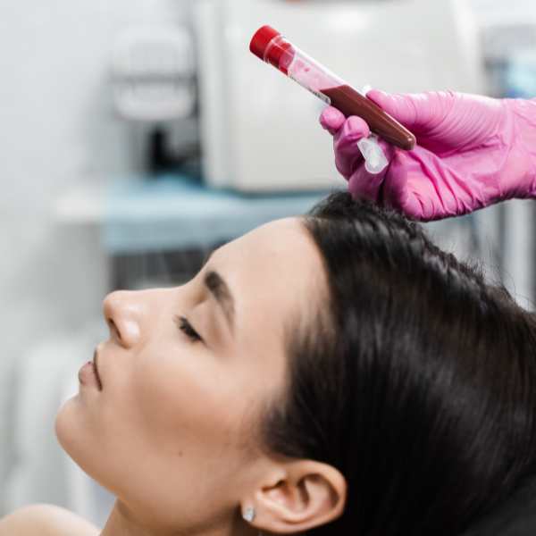 PRP Facial en la clínica de medicina estética Madrid