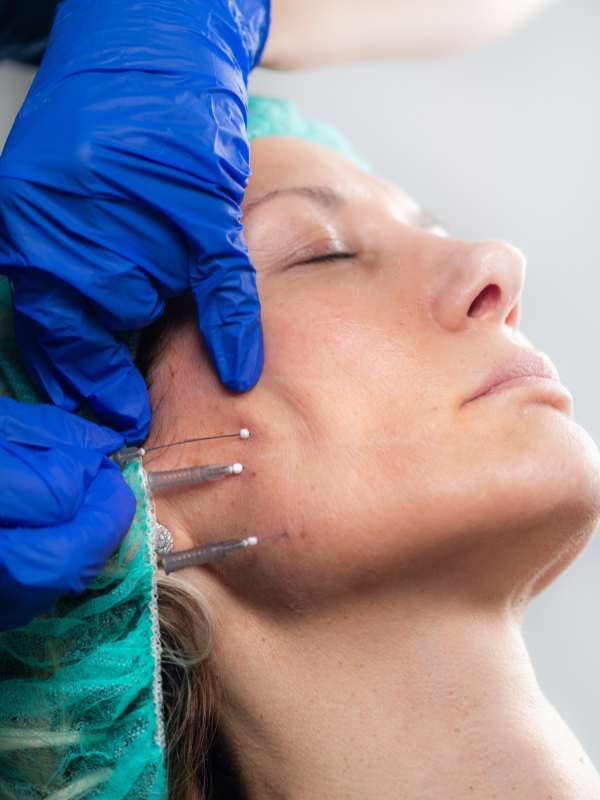 nuestros tratamientos de hilos tensores en la clínica de medicina estética en Madrid DA