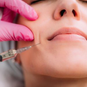 lineas de marioneta en Madrid. Tratamiento Clinica Medicina Estetica DA