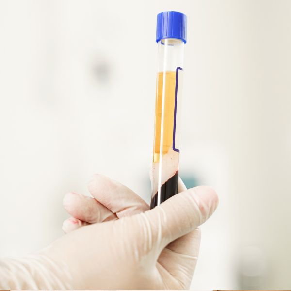 Plasma rico en plaquetas tratamiento PRP en Madrid