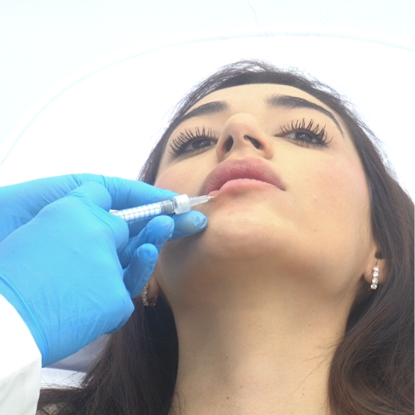 Aumento y perfilado de labios. Paciente de la Clínica de Medicina Estética DA en Madrid