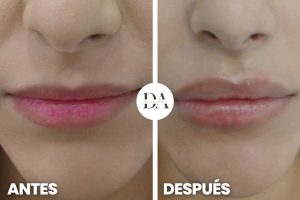 antes y después aumento de labios en la mejor Clinica de medicina estetica de Madrid. Clinica DA